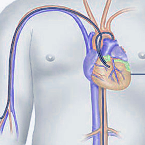 coronary-angiography