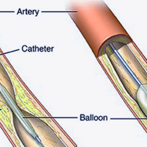 coronary-angioplasty