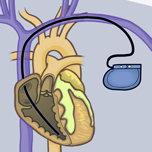 pacemaker-implantation