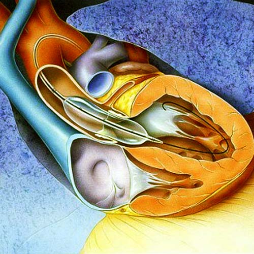 valvuloplasty-doctor-in-gurugram